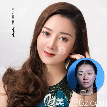 贵阳华美玻尿酸填充案例