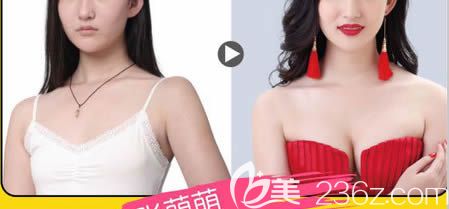 长春中妍刘晓吉自体脂肪隆胸案例效果对比图