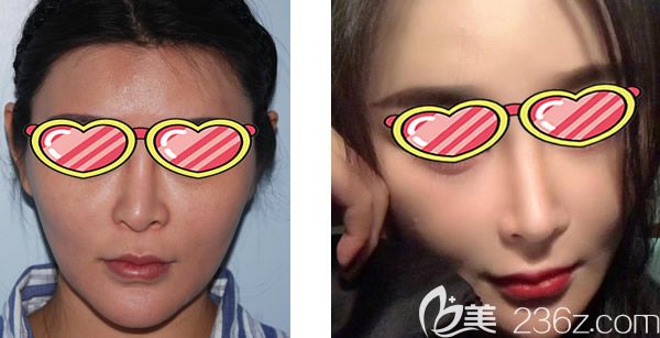 呼和浩特大韩整形白惠援医生歪鼻矫正效果好不好 呼和浩特大韩整形白惠援医生歪鼻矫正效果好不好