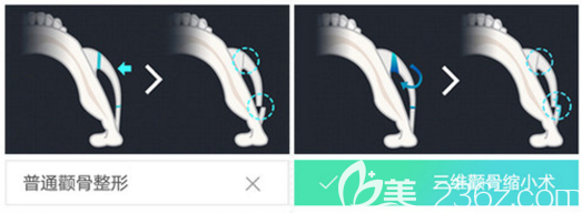 颧骨内推示意图