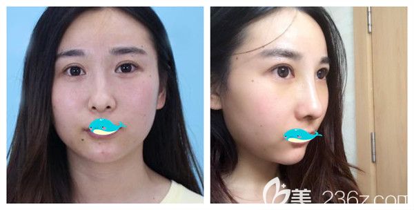 孝感天妃硅胶隆鼻综合术后5天对比照