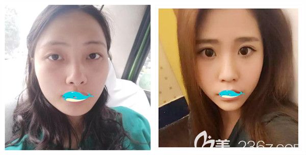 孝感天妃整形医院瘦脸除皱瘦脸案例展示