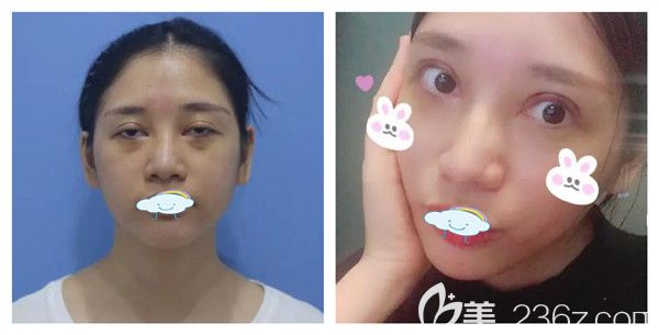 孝感天妃整形医院柳肖眼部修复全切双眼皮+开眼角+玻尿酸垫下巴术后7天对比案例 孝感天妃整形医院柳肖眼部修复全切双眼皮+开眼角+玻尿酸垫下巴术后7天对比案例