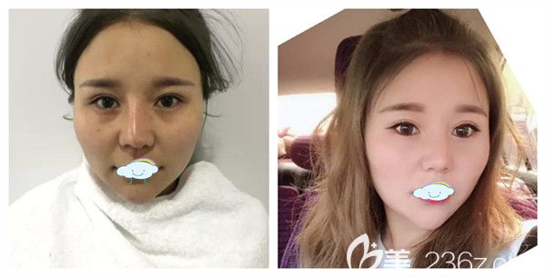 孝感天妃整形医院祛痘印+前后对比效果 孝感天妃整形医院祛痘印+前后对比效果