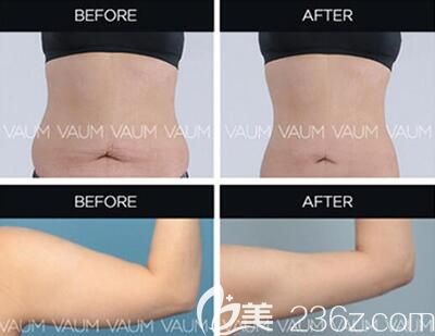 20190411_1554963792481743.jpg 吸脂手术.jpg