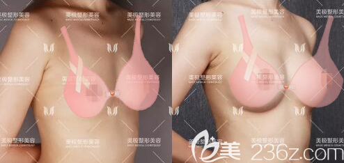成都美极整形医院达文隆胸术后对比图