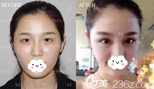 成都美极达文双眼皮术后效果