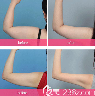 韩国VAUM整形外科胳膊吸脂效果图