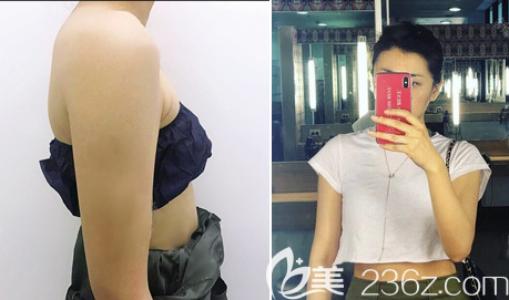 成都美极王伟手臂吸脂术后效果图 成都美极王伟手臂吸脂术后效果图