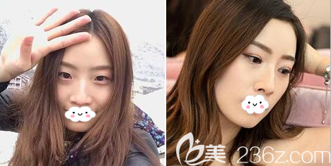 成都美极王伟双眼皮术前术后对比图 成都美极王伟双眼皮术前术后对比图