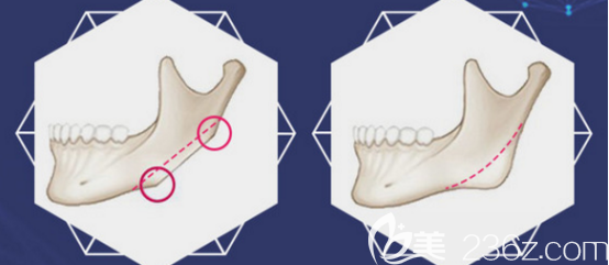 切除下颌角的手术示意图