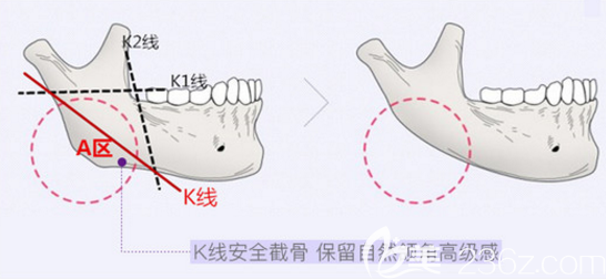 下颌角切除示意图