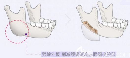 下颌角切除示意图2