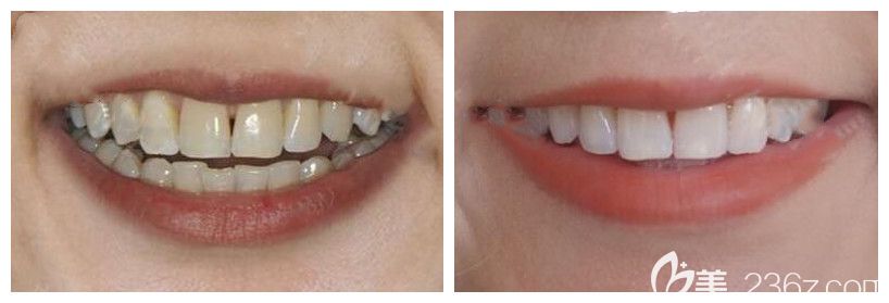 青岛维乐口腔董旭涛医生牙齿冷光美白案例 青岛维乐口腔董旭涛医生牙齿冷光美白案例