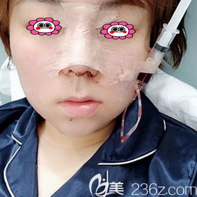 刚做完假体隆鼻的照片