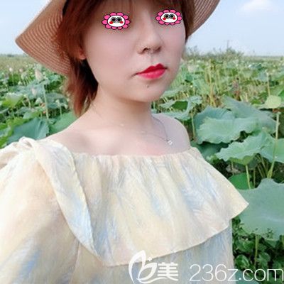 膨体隆鼻三个月的<span style=