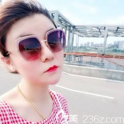 做膨体隆鼻一年的样子