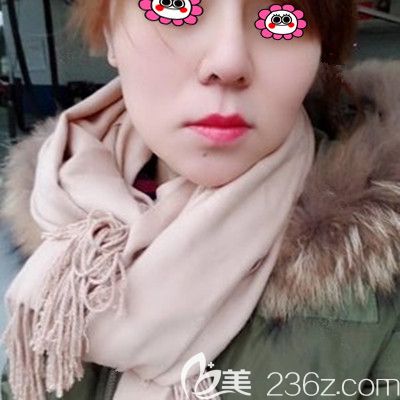 湘潭雅美做膨体隆鼻两年了，较近打算再去做个鼻翼缩小术