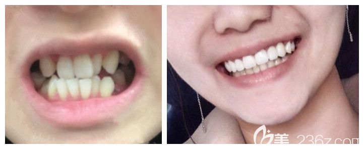 青岛维乐口腔孙雪医生隐形牙齿矫正案例 青岛维乐口腔孙雪医生隐形牙齿矫正案例