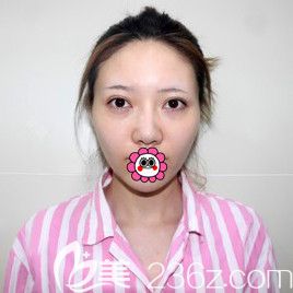 没做鼻子之前鼻梁比较低 没做鼻子之前鼻梁比较低