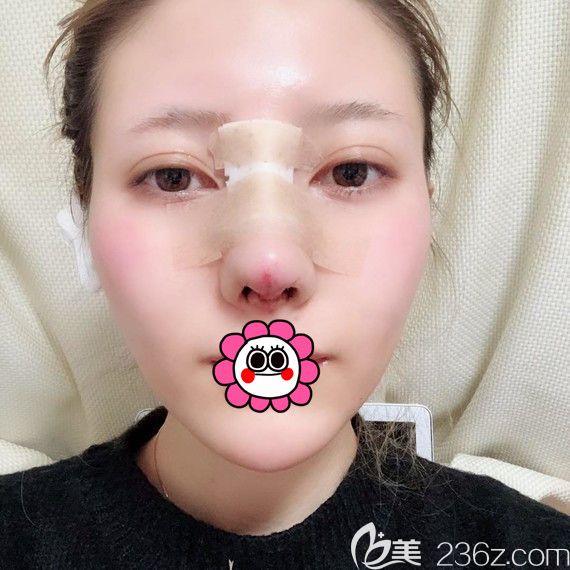 哈尔滨臻美鼻综合术后即刻 哈尔滨臻美鼻综合术后即刻