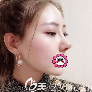 王丹丹肋软骨隆鼻半个月效果 王丹丹肋软骨隆鼻半个月效果