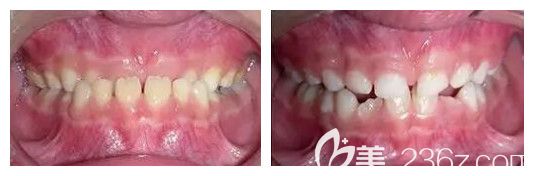 青岛维乐口腔杨春犁医生儿童反颌矫正效果图 青岛维乐口腔杨春犁医生儿童反颌矫正效果图