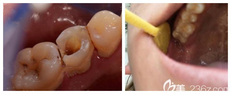 青岛维乐口腔田珊珊磨牙根管治疗案例