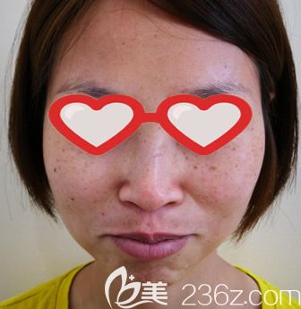 呼和浩特大韩整形皮秒激光祛斑前 呼和浩特大韩整形皮秒激光祛斑前