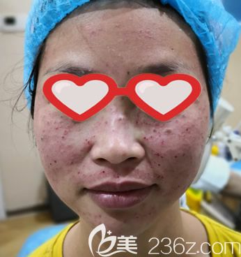 找呼市大韩整形陈琳医生激光祛斑即刻效果 找呼市大韩整形陈琳医生激光祛斑即刻效果