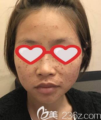 激光祛斑第二天图片 激光祛斑第二天图片