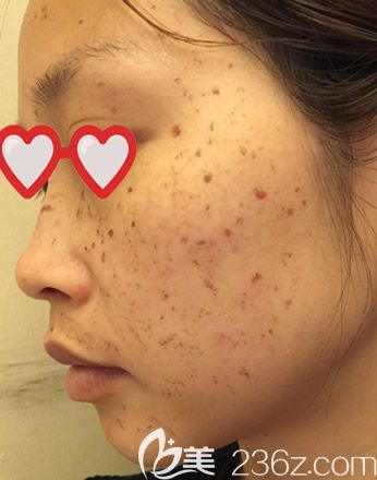 皮秒激光祛斑第三天脸有点痒 皮秒激光祛斑第三天脸有点痒