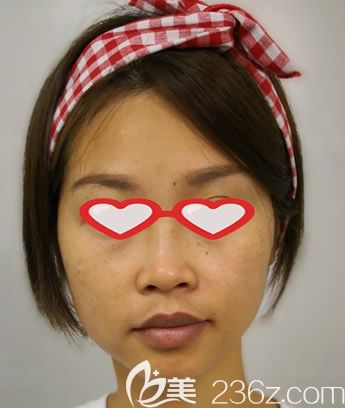 皮秒祛斑10天变化图片 皮秒祛斑10天变化图片