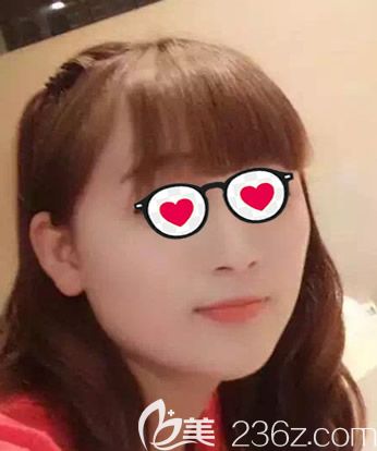 呼和浩特大韩整形注射瘦脸前照片 呼和浩特大韩整形注射瘦脸前照片