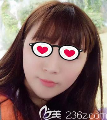 瘦脸除皱瘦脸半个月效果 瘦脸除皱瘦脸半个月效果