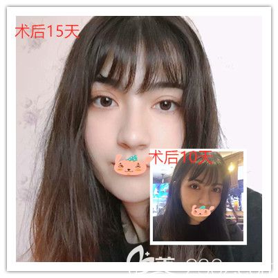 孝感天妃医美柳肖主任眼综合术后10天-15天恢复照片 孝感天妃医美柳肖主任眼综合术后10天-15天恢复照片