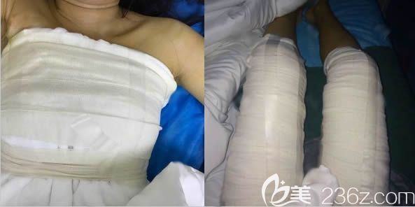 在长春中妍做脂肪隆胸和大腿吸脂术后当天照