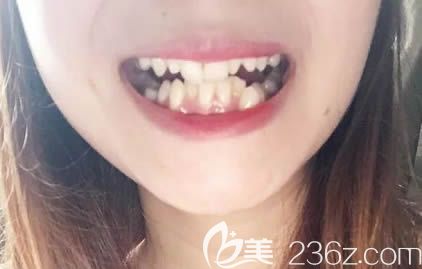 我做矫正前牙齿深覆颌的样子 我做矫正前牙齿深覆颌的样子