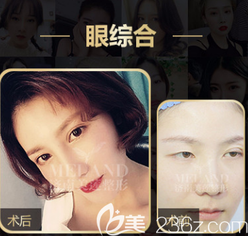 济南美莲眼综合案例一