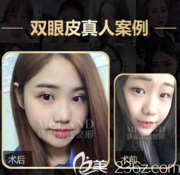 济南美莲眼综合案例二