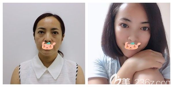 孝感天妃医美整形医院何琦蕾面部埋线提升前后对比案例展示 孝感天妃医美整形医院何琦蕾面部埋线提升前后对比案例展示