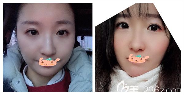 孝感天妃整形医院何琦蕾医生瘦脸术后案例效果对比图 孝感天妃整形医院何琦蕾医生瘦脸术后案例效果对比图