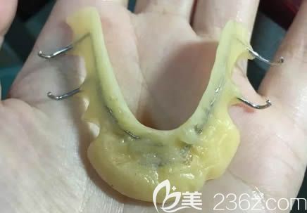 正畸中的平导图片 正畸中的平导图片