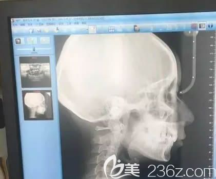 在长沙利尔口腔做矫正前排的ct片子 在长沙利尔口腔做矫正前排的ct片子