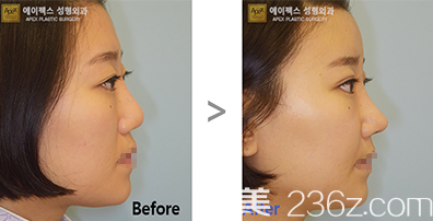 韩国爱佩思鼻综合隆鼻案例效果前后对比 韩国爱佩思鼻综合隆鼻案例效果前后对比