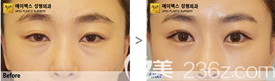 韩国爱佩思眼部综合整形案例效果对比图 韩国爱佩思眼部综合整形案例效果对比图