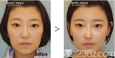韩国爱佩思自体脂肪面部填充案例 韩国爱佩思自体脂肪面部填充案例