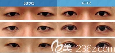 上睑下垂矫正手术案例 上睑下垂矫正手术案例