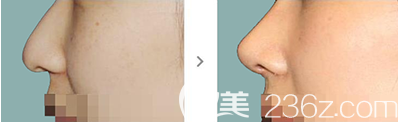 韩国爱佩思APEX整形外科宋铉锡院长鼻部整形案例效果对比图 韩国爱佩思APEX整形外科宋铉锡院长鼻部整形案例效果对比图