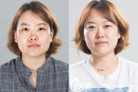 贵阳美莱4C钻石婴儿肌案例 贵阳美莱4C钻石婴儿肌案例